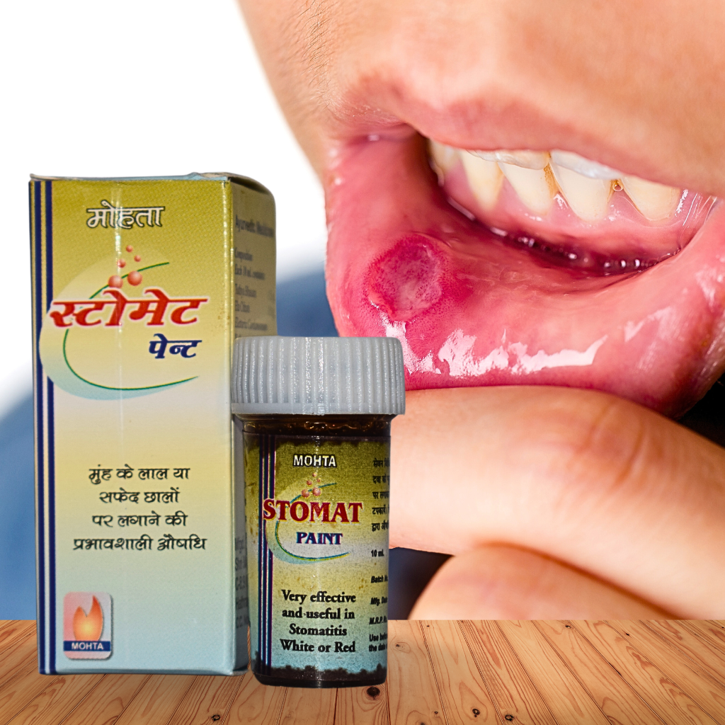 STOMAT PAINT (FOR- MOUTH ULCERS) (SHRI MOHTA RASAINSHALA ,10ML)